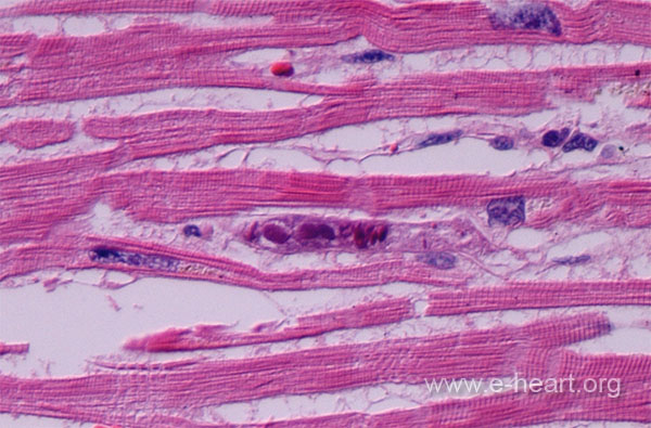 Cytomegalovirus